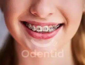 Consejos y Recomendaciones para cuidar brackets-odentid